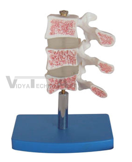 Cutaway Osteoporosis Pharmaceutical and Anatomical Model Gifts